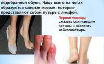 Виды и лечение мозолей между пальцами ног