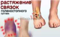 Подвернула ногу, что делать?
