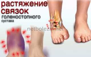 Вывих лодыжки